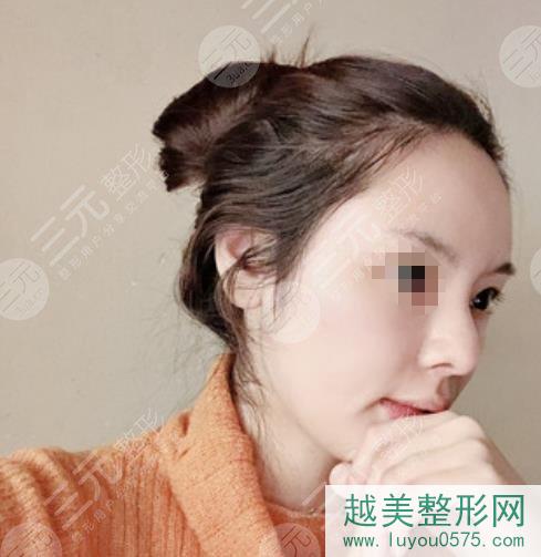 上海华美李健做鼻子案例