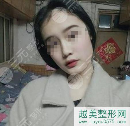 上海九院戴传昌玻尿酸隆鼻案例