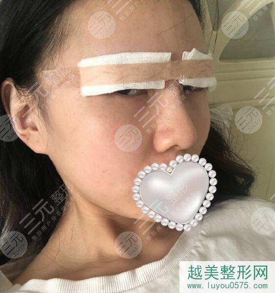 广州市第一人民医院双眼皮案例图？
