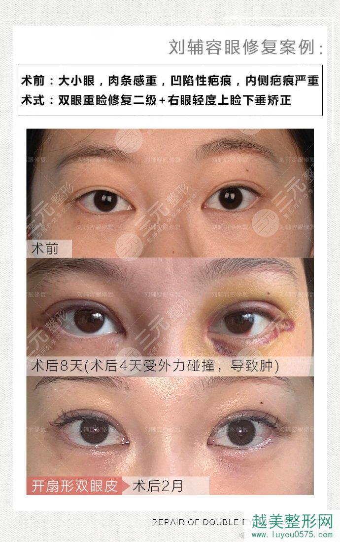 刘辅容双眼皮修复案例