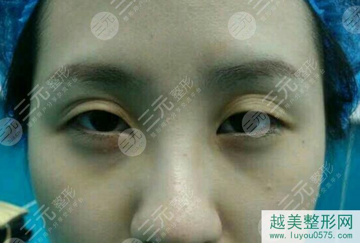 上海华美医疗美容医院双眼皮修复前