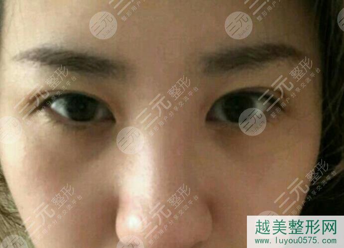 上海华美医疗美容医院双眼皮修复后
