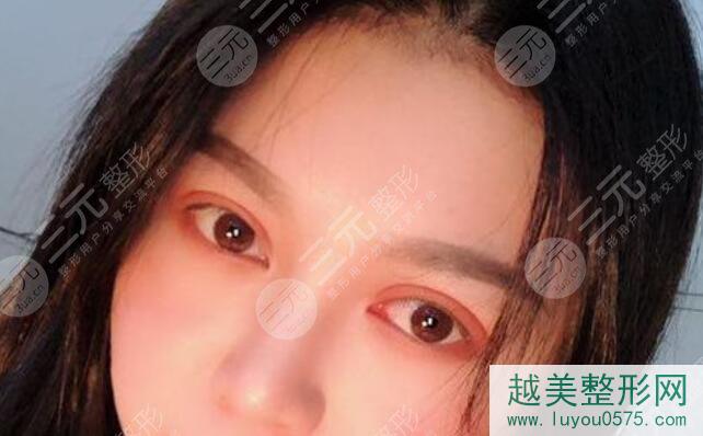 中国医学科学院整形外科医院双眼皮修复后4周