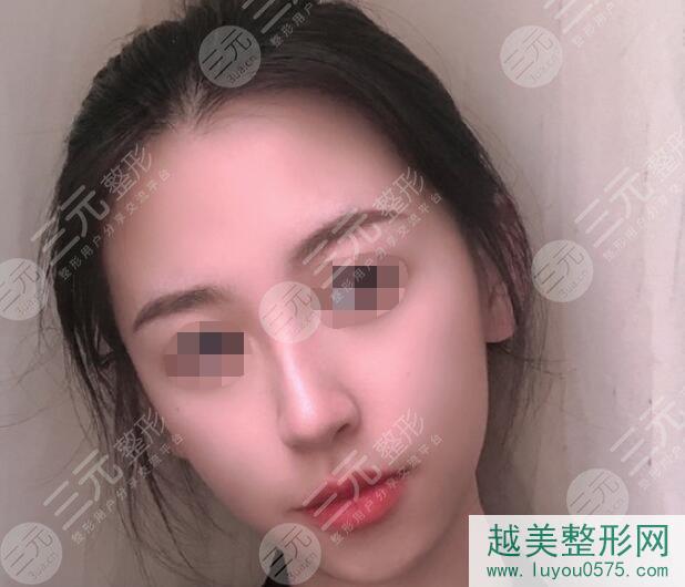 上海首尔丽格整形医院隆鼻案例一个月