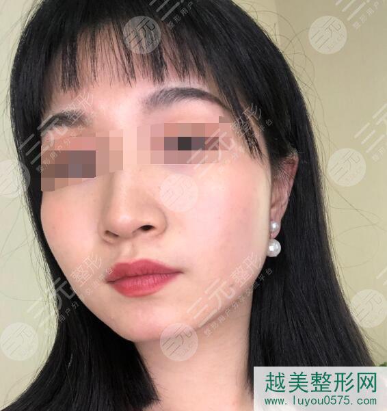 山东省立医院整形外科曹永倩医生做激光美肤祛斑术后15天