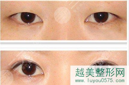 北京高难度双眼皮修复成功案例