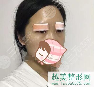 宁海县第一医院整形科双眼皮案例前