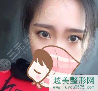宁海县第一医院整形科双眼皮案例后一个月