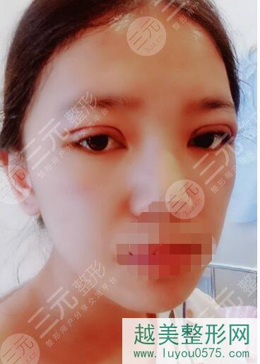 宁波东海医院整形科眼部手术手术案例后