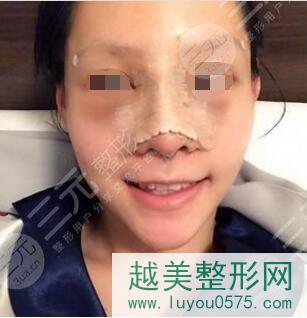 南京张少博医生隆鼻手术后一周