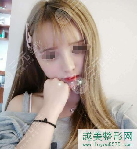 上海九院美容整形科隆鼻术后30天