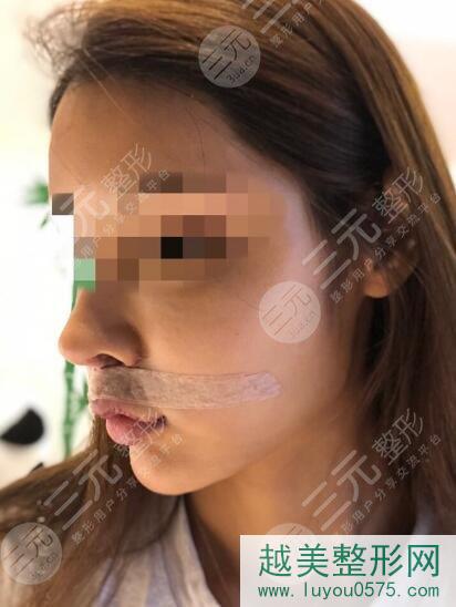 尹宁北唇裂手术图片