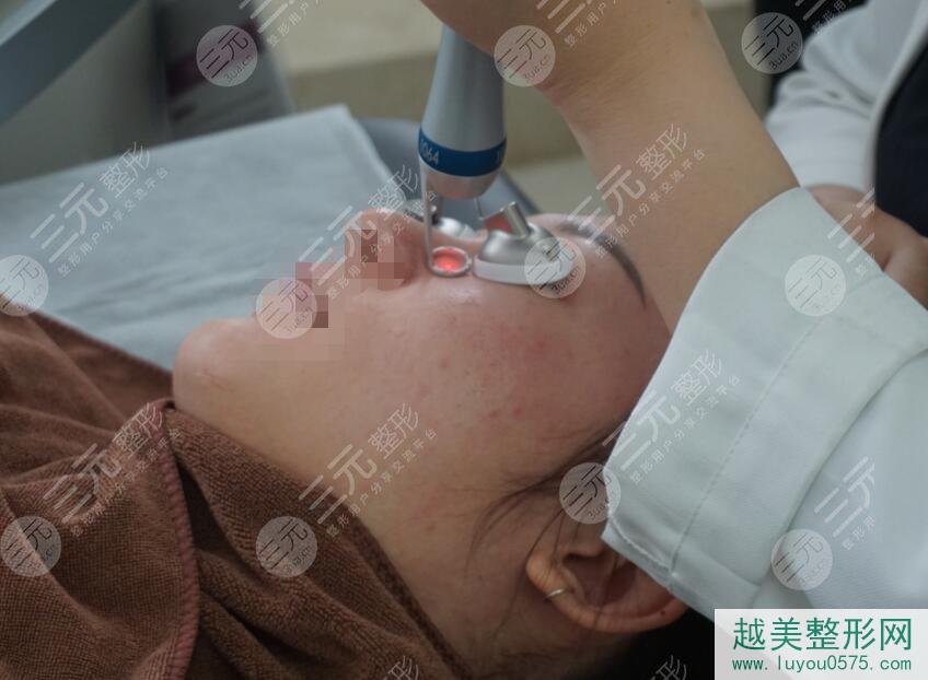 广州市皮肤病防治所激光美肤祛斑案例