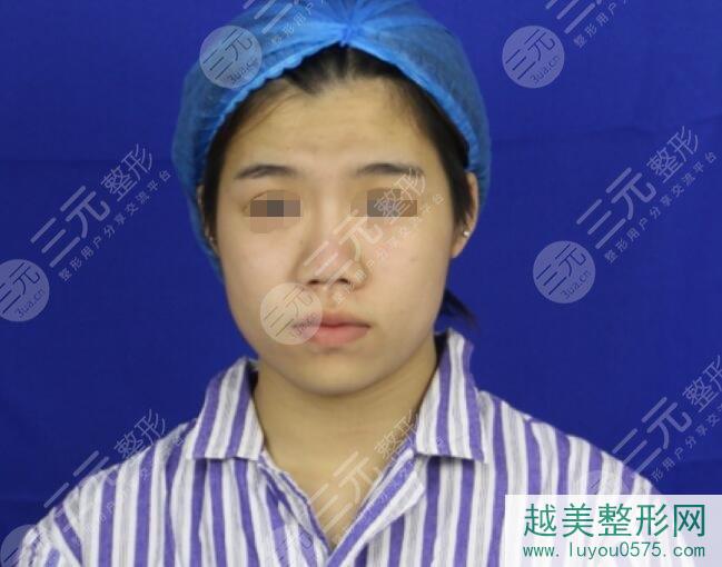 上海九院戴传昌肋骨鼻部手术案例