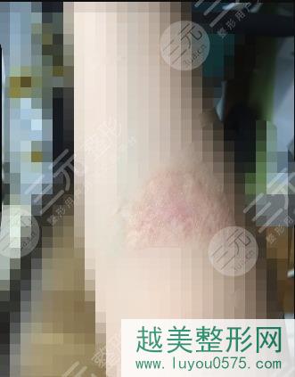 贵州省人民医院激光美容科激光祛疤案例