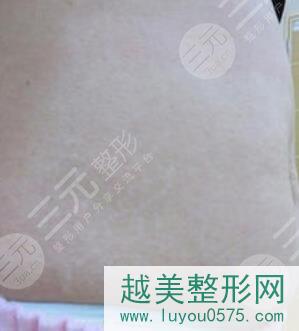 上海第九人民医院激光美容科祛妊娠纹果图
