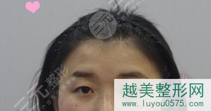 北京协和医院整形科双眼皮案例