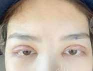 哈尔滨211美容科双眼皮手术案例