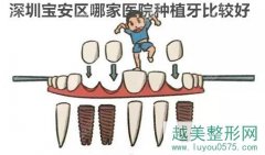 走访了深圳宝安区几家做种植牙比较好的牙科医院,top1竟然是
